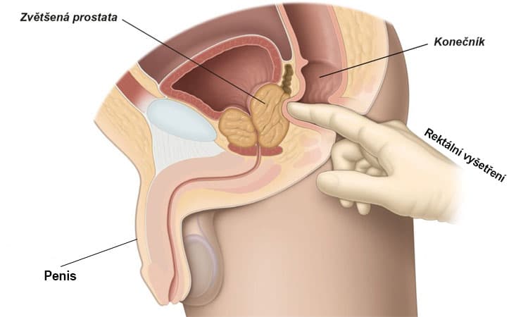 Co to je prostata a jakou funkci zastává?