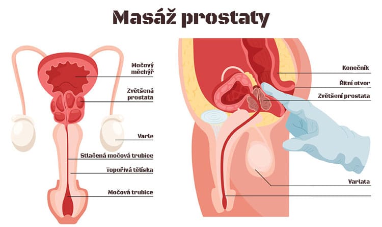 Jak na masáž prostaty